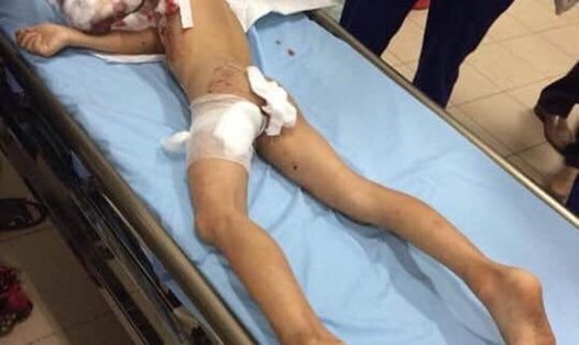 Bé trai 7 tuổi ở Thái Nguyên bị chó lai cắn