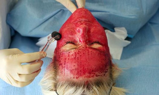 Người sử dụng dịch vụ “mặt nạ ma cà rồng” có thể bị truyền nhiễm các bệnh lây qua đường máu, nhất là HIV. 