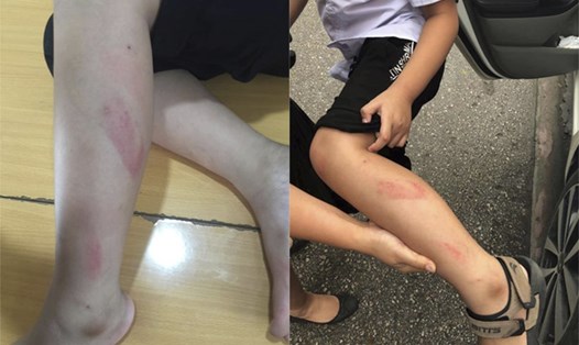 Học sinh Đ. bị cô giáo đánh vào chân trong giờ kiểm tra học kỳ. Ảnh: Minh Khang.