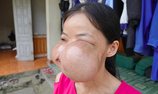 Chị Hậu với khối u “đeo bám” hơn 15 năm qua, chèn mất cả mắt, méo miệng, gẫy răng, bẹp mũi... Ảnh: P.V