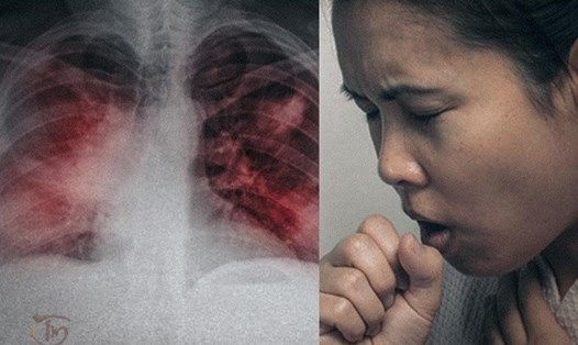 Triệu chứng viêm phổi ở bệnh nhân