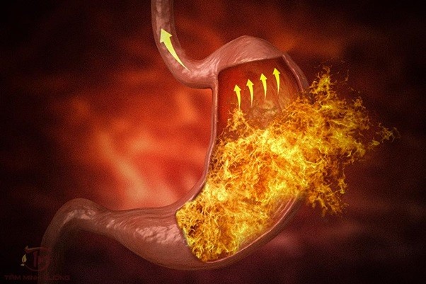 Bị trào ngược dạ dày có nguy hiểm không, người bệnh phải làm sao?