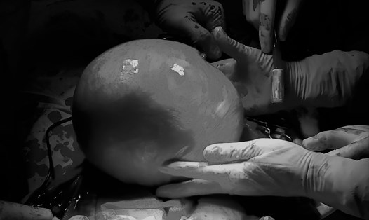 Khối u xơ tử cung có đường kính 20cm được bác sĩ phẫu thuật cắt bỏ.