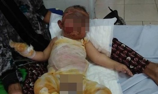 Một cháu bé bị bỏng được chữa trị tại bệnh viện. Ảnh: Fb