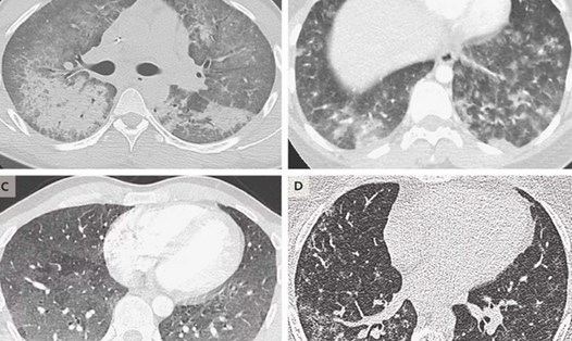 Hình ảnh scan phổi của 4 bệnh nhân tuổi từ 19 đến 49, cho thấy dấu hiệu tổn thương do sử dụng thuốc lá điện tử. Ảnh: New England Journal of Medicine.