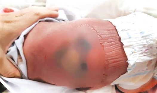 Trẻ sơ sinh bị bỏng nặng do nằm hơ than cùng mẹ được điều trị tại BV Nhi đồng 2 (TPHCM). Ảnh BV cung cấp