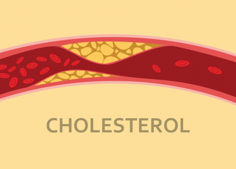 Thừa cholesterol trong máu. Ảnh: Vinmcec
