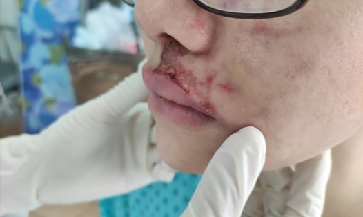 Một cô gái 26 tuổi sưng phù mặt, mưng mủ do tiêm filler làm đầy má ở thẩm mỹ viện. Ảnh: Bệnh viện Da liễu TPHCM