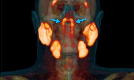 Cặp tuyến nước bọt thứ tư được các bác sĩ Hà Lan phát hiện nằm ở nơi khoang mũi nối với cổ họng. Ảnh: NY Post
