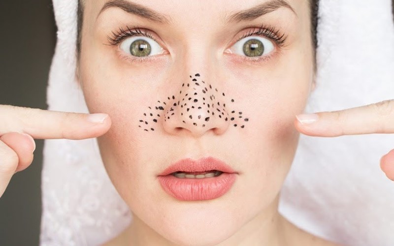 3 cách trị mụn đầu đen cực đơn giản tại nhà
