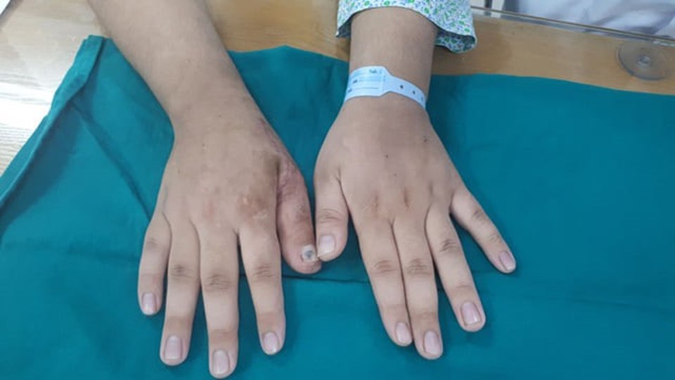 Bàn tay sau ca phẫu thuật chuyển ngón chân thành ngón tay. Ảnh do bệnh viện cung cấp. Bàn tay sau ca phẫu thuật chuyển ngón chân thành ngón tay. Ảnh do bệnh viện cung cấp.