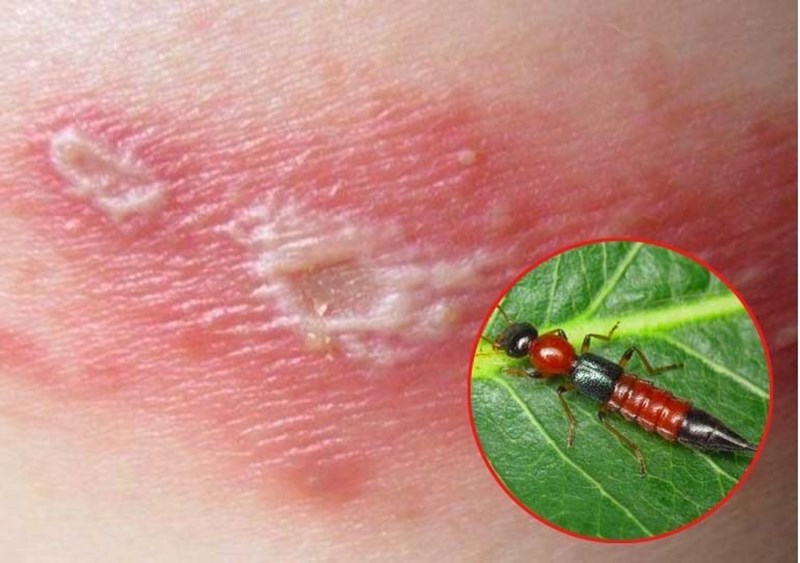 Làm thế nào để sử dụng vợt muỗi để diệt kiến ba khoang đuôi nhọn?
