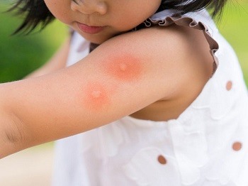 7 mẹo trị muỗi đốt cho trẻ nhỏ trong mùa dịch sốt xuất huyết