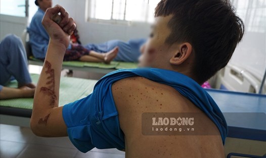 Trên lưng, mặt, tay, chân... đều là những vết thương do bị chủ quán bánh xèo ở Bắc Ninh tra tấn hơn 1 tháng nay. Ảnh: Tùng Giang.