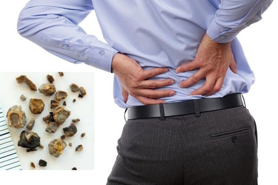 Sỏi thận là hiện tượng các chất khoáng trong nước tiểu lắng đọng lại ở thận, lâu ngày kết lại tạo thành sỏi. Ảnh: Lao Động.