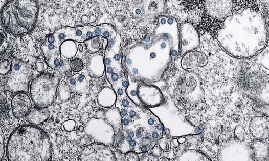Mục sở thị cách virus Corona mới gây dịch COVID-19 xâm nhập tế bào cơ thể người bệnh ở Mỹ. Ảnh: CDC.