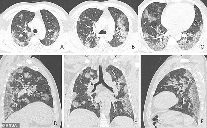 Hình ảnh trực quan mà SARS-CoV-2 gây ra với phổi của người bệnh