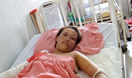 Nguyễn Ngọc Như Huỳnh đang điều trị tại Bệnh viện Chợ Rẫy (TP.Hồ Chí Minh). Ảnh: MP