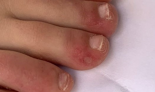 "Ngón chân COVID-19" - một biểu hiện lạ của dịch bệnh. Ảnh: BBC