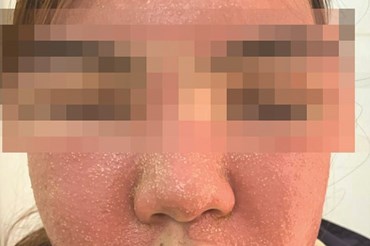 Khuôn mặt bệnh nhân bị ban đỏ, sưng phù sau khi đắp mặt nạ đông y. Ảnh: Bệnh viện cung cấp