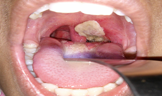 Triệu chứng dễ nhận thấy nhất của bệnh bạch hầu là hình thành mảng màu xám, dày ở họng và amidan. Ảnh: BVCC