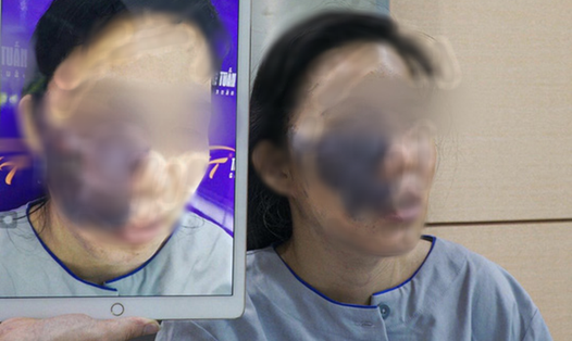 Khuôn mặt bệnh nhân trước và sau khi được phẫu thuật. Ảnh do bác sĩ cung cấp.