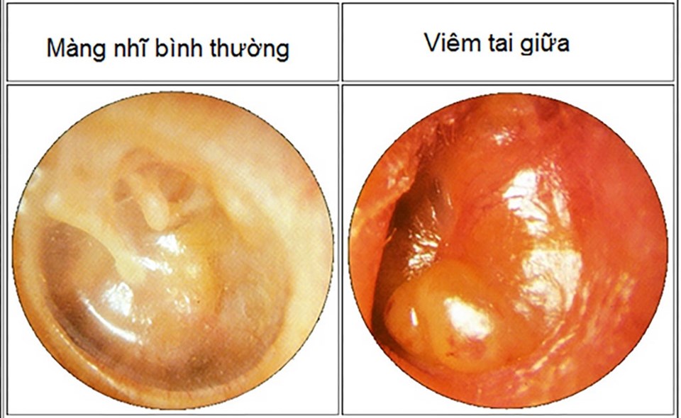So sánh màng nhĩ bình thường và viêm tai giữa. Ảnh: Bệnh viện Tai mũi họng Sài Gòn
