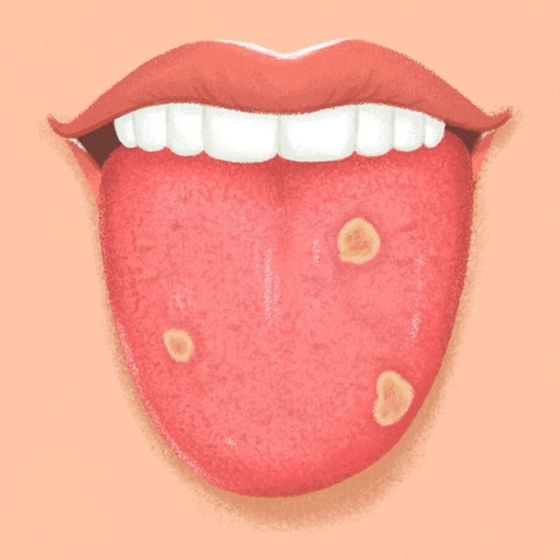 Làm thế nào để chăm sóc cho lưỡi không bị đen?
