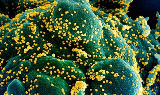 Một tế bào (xanh dương/xanh lục) bị nhiễm nặng các hạt virus SARS-CoV-2 (màu vàng), được phân lập từ bệnh nhân COVID-19 và chụp tại NIAID, Fort Detrick, Maryland, Mỹ. Ảnh: NIAID/AFP.
