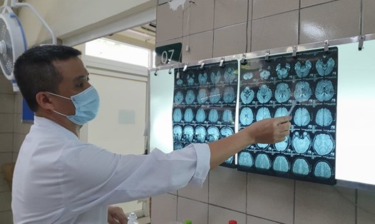 Hình ảnh phim cộng hưởng từ sọ não có tổn thương chất trắng lan tỏa trên não. Ảnh: Mai Thanh