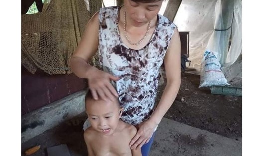 Bé Nông Việt Trung với lồng ngực bị lõm do dị tật. Ảnh: NVCC