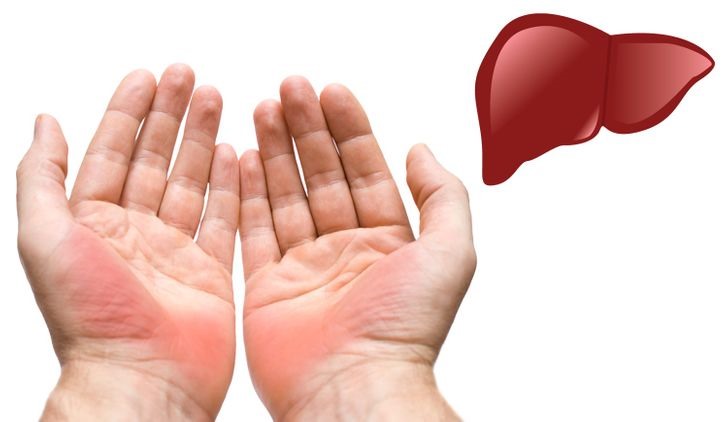 Bàn tay với những dấu hiệu khác lạ cảnh bảo về sức khỏe của bạn