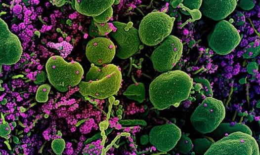 Ảnh vi điện tử quét màu của một tế bào (màu xanh lá cây) bị nhiễm nặng các hạt virus SARS-CoV-2 (màu tím) được phân lập từ mẫu bệnh nhân. Ảnh: NIAID/AFP