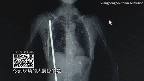 A female Chinese construction worker miraculously survives a terrible work accident, being stabbed by an iron bar in the body. Photo: Quang Dong Television