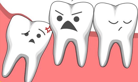 Răng khôn mọc lệch thường gây ra nhiều phiền toái. Ảnh: Từ điển bệnh học