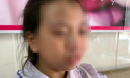 Nữ sinh bị cô giáo tát trên lớp ở Hà Giang. Ảnh Hoàng An.