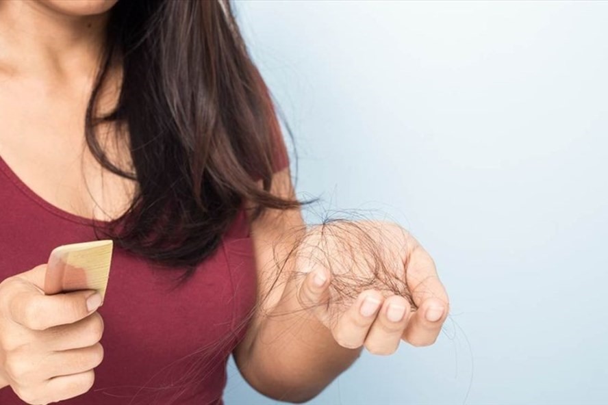Da đầu khô cũng là nguyên nhân khiến cho tóc bị rụng nhiều trong mùa đông. Ảnh LĐO
