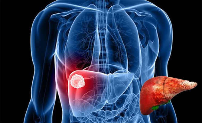 6 t&aacute;c nh&acirc;n g&acirc;y ung thư gan nguy hiểm m&agrave; bạn cần biết
