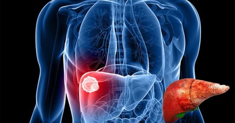 6 tác nhân gây ung thư gan nguy hiểm mà bạn cần biết