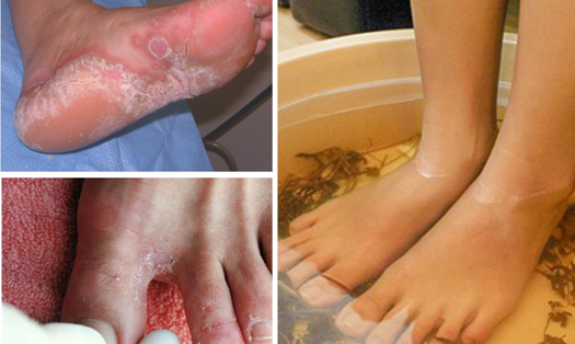 Với các trường hợp bị nhẹ, có thể áp dụng một số cách trị "nước ăn chân" tại nhà để kiểm soát triệu chứng. Ảnh đồ họa: P.Công