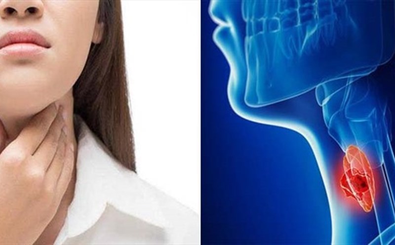 Những dấu hiệu nhận biết căn bệnh ung thư hạ họng