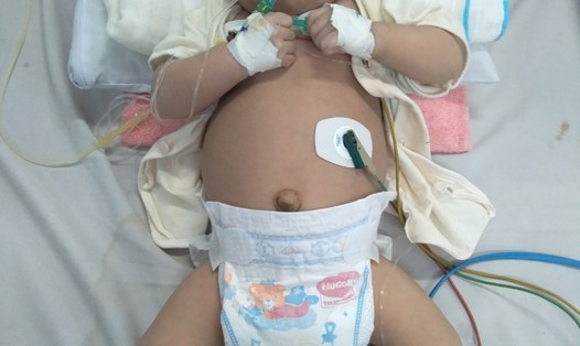 Bé Trần Thành Phong (9 tháng tuổi, quê ở xã Nghĩa Trung, huyện Tư Nghĩa, tỉnh Quảng Ngãi) bị viêm phổi nặng đang điều trị ở Bệnh viện Nhi đồng 1, TPHCM. Ảnh: GĐCC