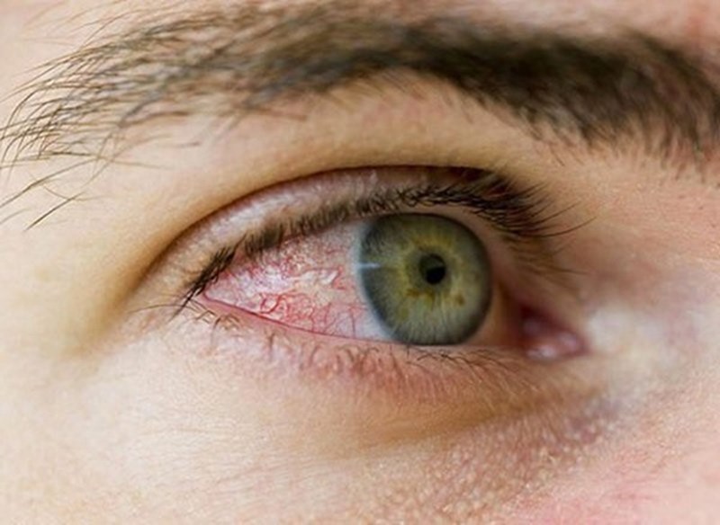 Có cách nào để tránh ngứa mắt khi đeo lens không?
