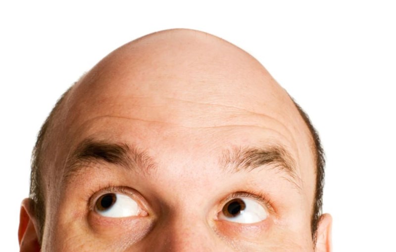 Di truyền có ảnh hưởng đến rụng tóc nam không?
