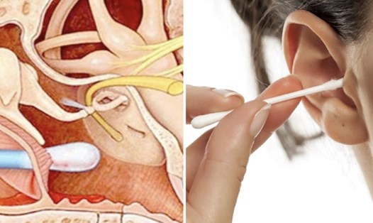 Không nên đưa tăm bông vào sâu ống tai để tránh những chấn thương nguy hiểm.