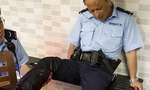 Cảnh sát Hong Kong bị lợn rừng cắn trọng thương. Ảnh: Facebook