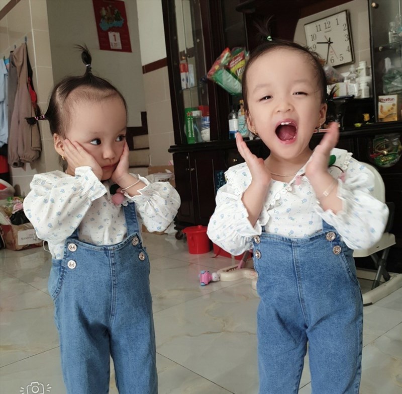 Cặp song sinh dính liền Trúc Nhi - Diệu Nhi sau hơn 1 năm phẫu thuật