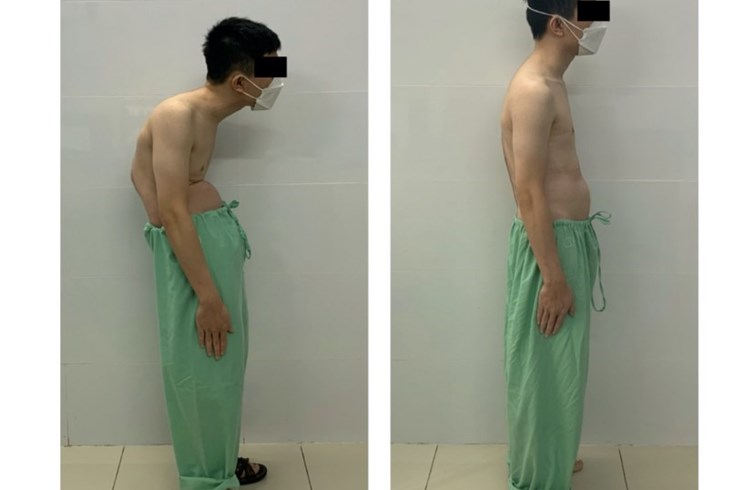 Phẫu thuật thành công cho bệnh nhân bị còng cột sống Phẫu thuật thành công cho bệnh nhân bị còng cột sống