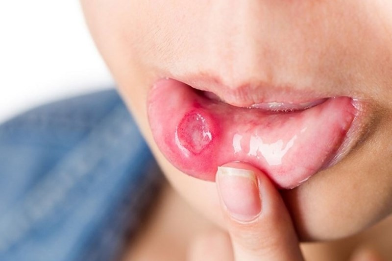 Nhiệt miệng kéo dài có thể gây ra những vấn đề sức khỏe nghiêm trọng không?
