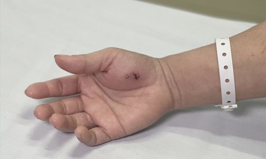 Hình ảnh vết cắn trên tay bệnh nhân. Ảnh: BVCC